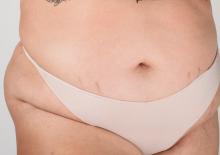 Rozstępy na brzuchu po ciąży